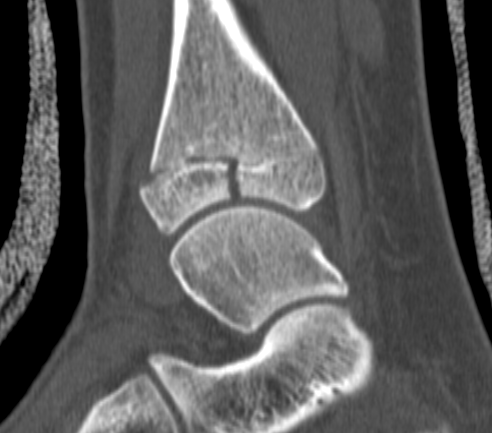 Tillaux Fracture CT Sagittal
